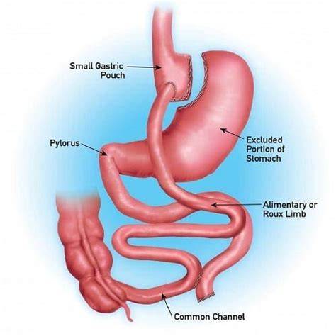 Gastric Bypass Revision Find Surgical And Non Surgical Weight Loss