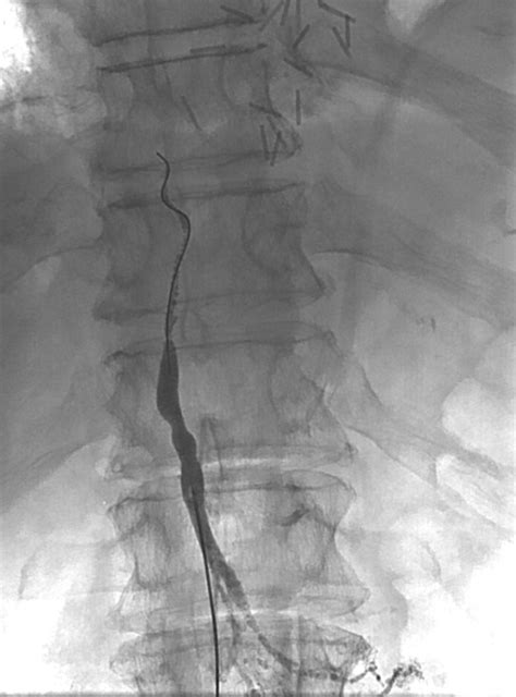 Chylothorax Percutaneous Embolization Of The Thoracic Duct Operative