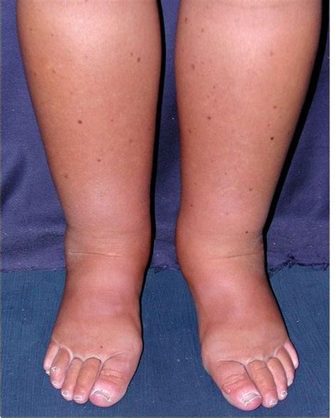 What Are The Possible Complications Of Lymphedema