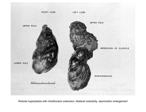 Pathology Outlines Multinodular Goiter