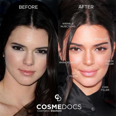 Kendall Jenner Kendall Jenner Plastic Surgery Celebrity Plastic