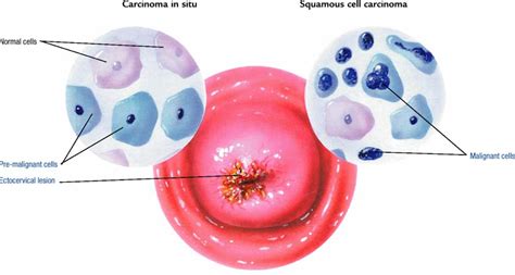 Pathophysiology Of Cervical Cancer