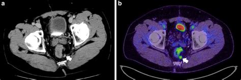 Imaging Of Local Recurrence After Secondary Lar For Intramural