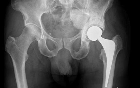 Total Hip Replacement Thr Paddington Physiotherapy And Podiatry