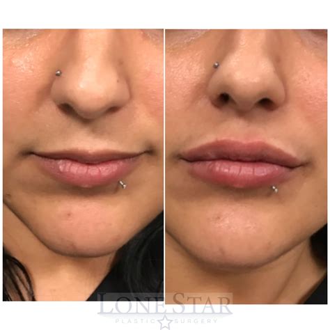 dermal fillers lips before and after