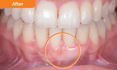 Gingival Gum Grafting The Periodontists