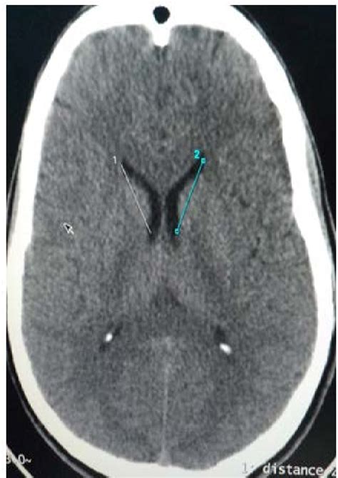 Ct Axial Image Of The Brain Showing The Length Of Body Of The Lateral