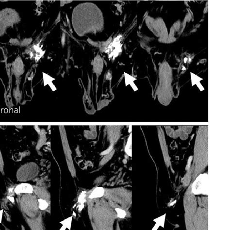 Enhanced Ct Scan Showing A Solid Soft Tissue Mass With Calcification