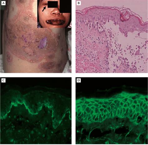 A Polymorphic Cutaneous Eruption Appeared Several Days After