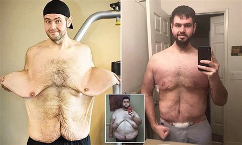 Man Can Finally Move Freely After Having Excess Skin Removed Daily Mail Online