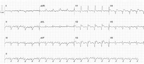 Ventricular Flutter Litfl Ecg Library Diagnosis