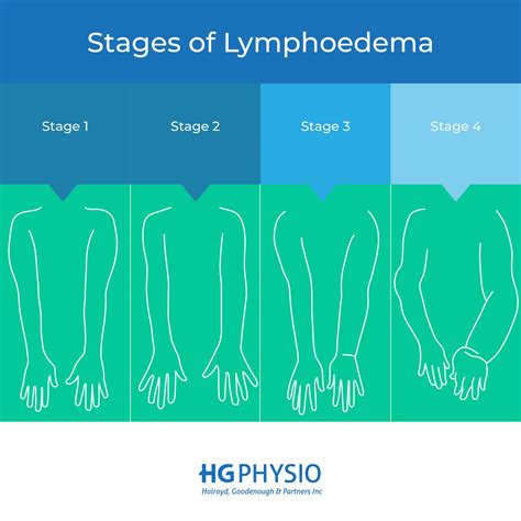 What Is Lymphoedema Hg Physio