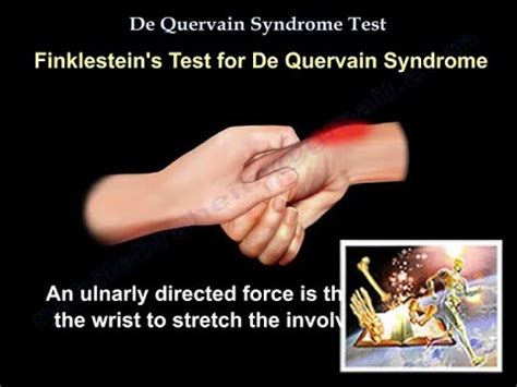 De Quervain Syndrome Test Everything You Need To Know Dr Nabil