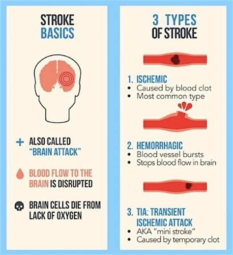 Sign Against Stroke On Twitter Stroke Basics And The Three Types Of