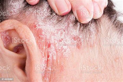 Psoriasis Psoriatic Skin Disease In Hair Stock Photo Download Image