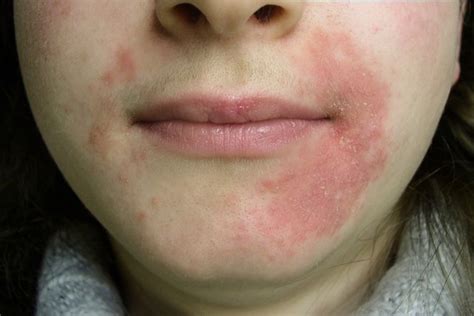 Dermatite o que é sintomas tipos causas e tratamento com fotos Seja Saudável