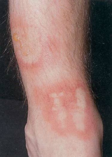 Erythema And Blistering On The Lower Leg Caused By Undiluted