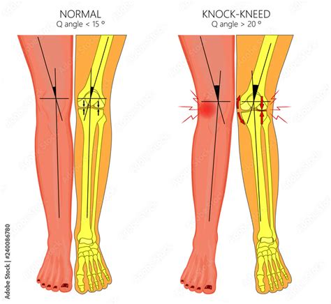 Vector Illustration Diagram Shapes Of Human Legs Normal And Curved