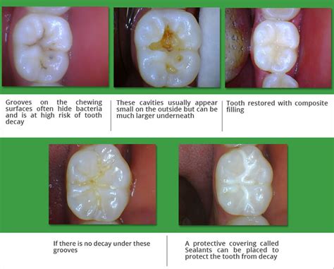 How Are Sealants Applied To Teeth Teethwalls
