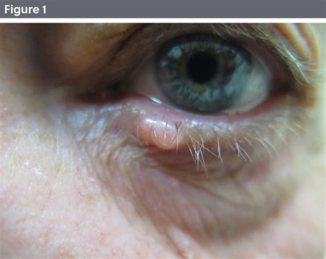 Eyelid Lesions All You Need To Know