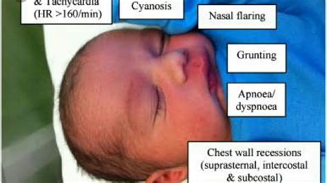 Hyaline Membrane Disease Risk Factor Clinical Features Sign And