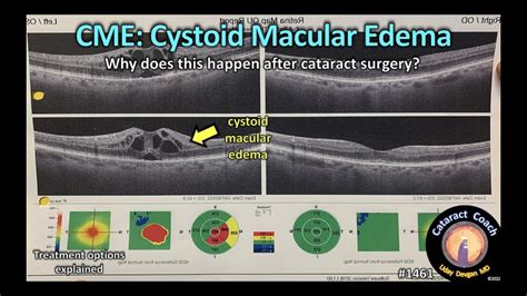 Cataractcoach 1461 Cystoid Macular Edema Cme After Cataract Surgery
