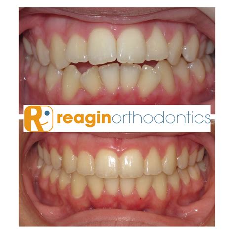 Braces Before And After Reagin Orthodontics Summerville Sc