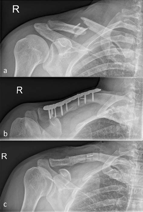 Midshaft Clavicle Fracture Ota 15c2 Preoperative A After