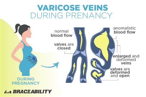 1 Vulvar Varicosities Guide What Are Pelvic Varicose Veins
