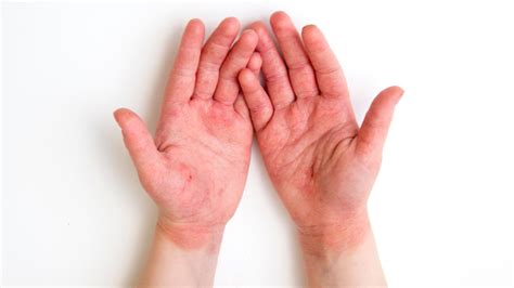 Heres What You Need To Know About Type 2 Inflammation And Eczema