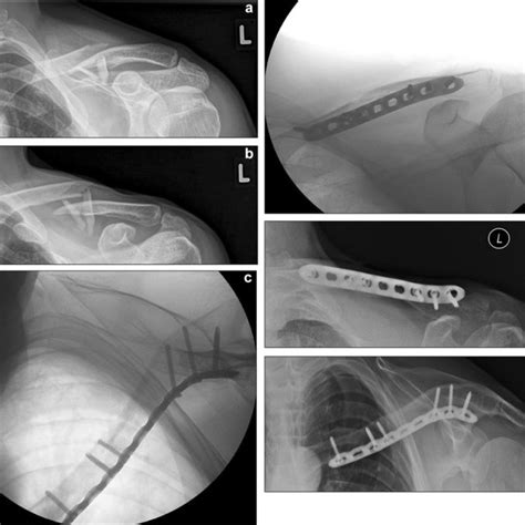 A B Comminuted Displaced Midshaft Clavicle Fracture Left With