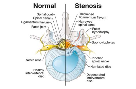 Lumbar Stenosis Causes Symptoms And Treatment Options For Narrowing