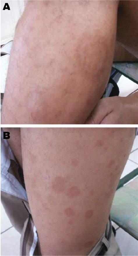 Erythema Migranslike Rash On The Left Leg Of A 28 Year Old Patient