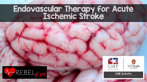 Endovascular Therapy For Acute Ischemic Stroke Rebel Em Emergency