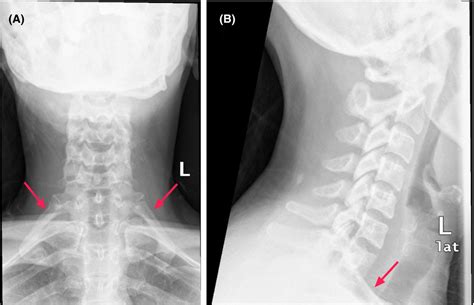 Cervical X‐ray Showing Bilateral Complete Cervical Ribs Red Arrows