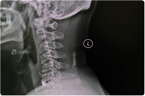 Spondylosis Cervical Spine X Ray