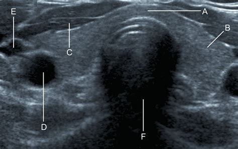 Transverse Ultrasound Through The Thyroid Gland The Bmj