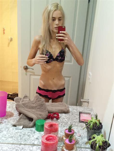 Anorexic Teen Starved Self For A Week And Was Hours Away From Death