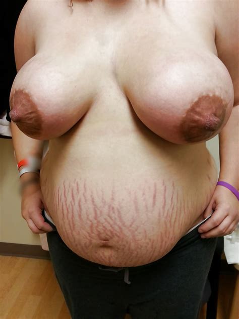 Big Nippled Women With Stretch Marks Or Scars Pics Xhamster