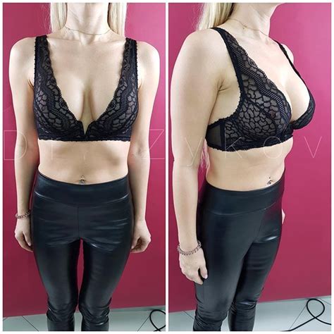 Pin On Breast Augmentation Before And After Photo