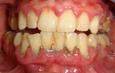 Hygiene Visits During Orthodontics Schur Orthodontics