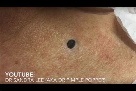 Pimple popper claims gruesome viral videos make her 900,000 subscribers 'feel happy'. The Reason Why People Are Obsessed With Pimple Popping Videos