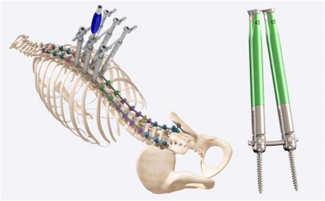 Spinal Fixation Spartan Medical Advanced Medical Technologies