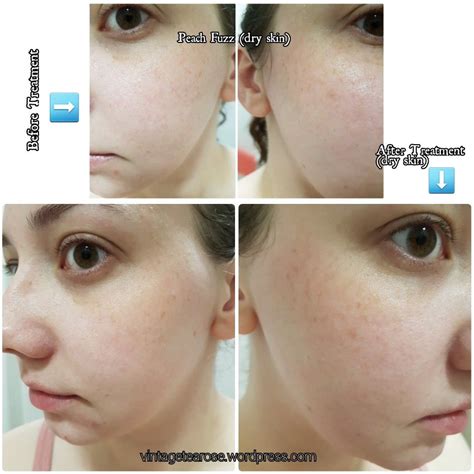 My Experience Dermaplaning Before And After Photos Beauty Treatments