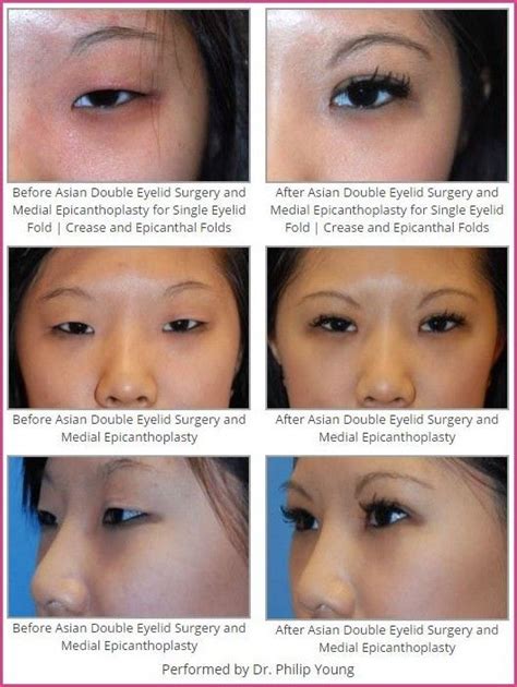 How To Make Your Eyes Bigger Surgery Canter Barbara