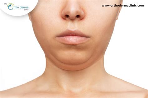 Double Chin Causes And Contributing Factors