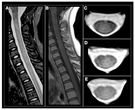 Biomedicines Free Full Text Spinal Cord Involvement In Ms And Other