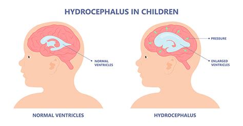 Hydrocephalus Diagnosis Symptoms Treatment More Choc