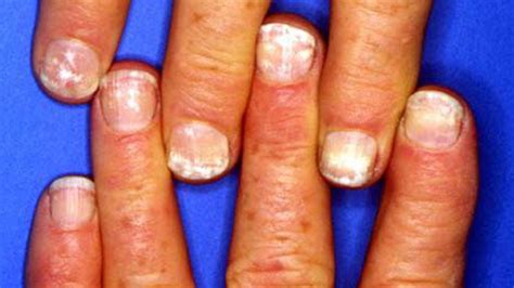 0 Result Images Of White Spots On Fingernails Deficiency Png Image