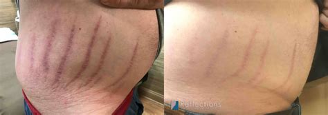 Stretch Marks Removed With Fraxel Laser And Microneedling Before And